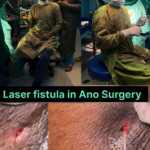 fistula-in-ano.png
